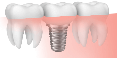 Implantes dentales: Dudas usuales ante el tratamiento