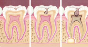 ¿Qué es la Caries Dental?